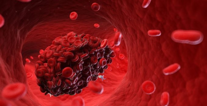What Causes Blood Clots? 11 Things That Can Raise Your Risk